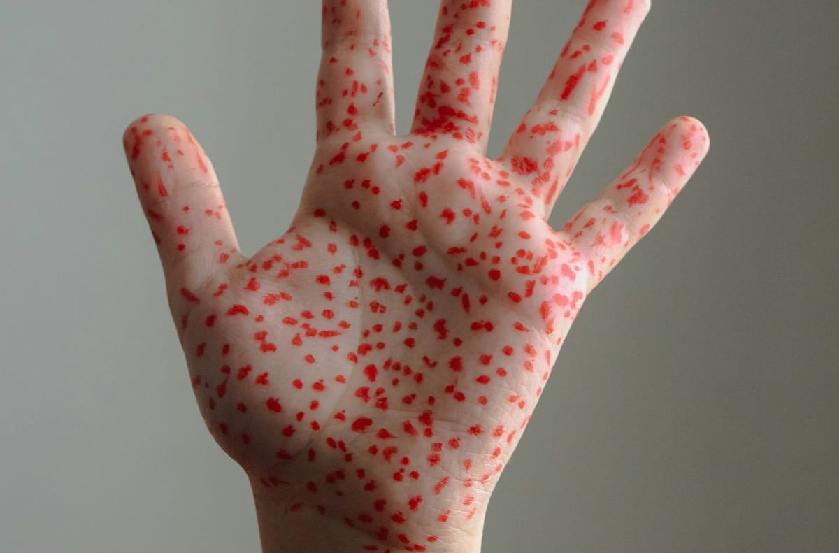 New Mexico health officials warn of measles risk ahead of summer travel and events
