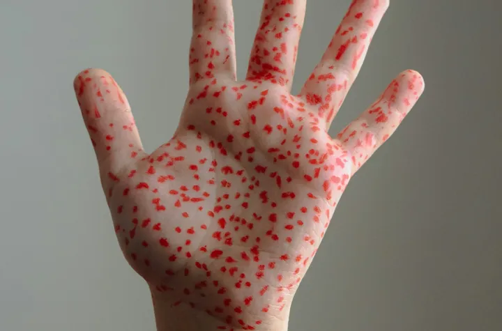 New Mexico health officials warn of measles risk ahead of summer travel and events